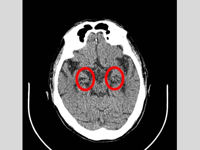 アルツハイマー型認知症の患者様のCT画像